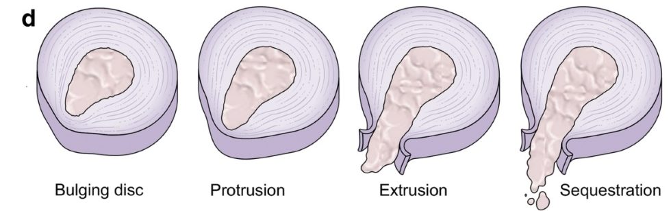 Lumbar disc injury - LivFit Physio Mornington