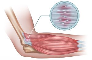 picture that describes what tennis elbow is 
